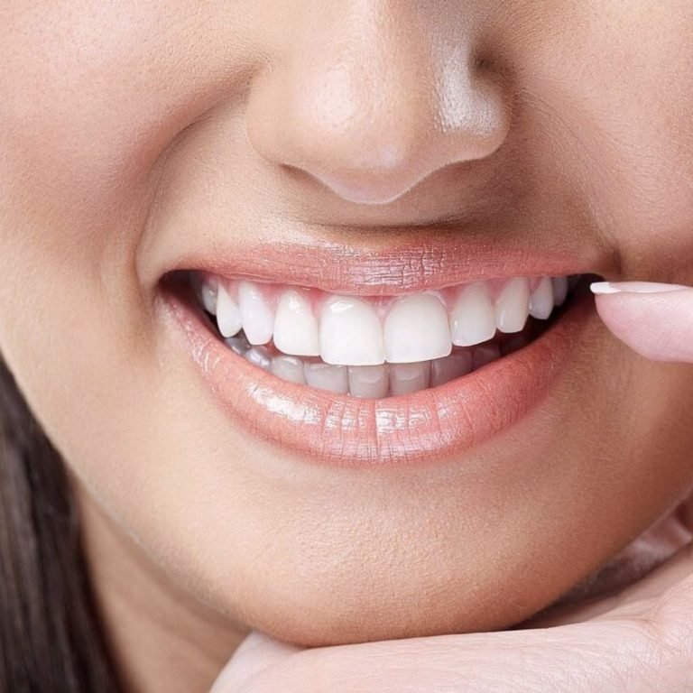teeth whitening